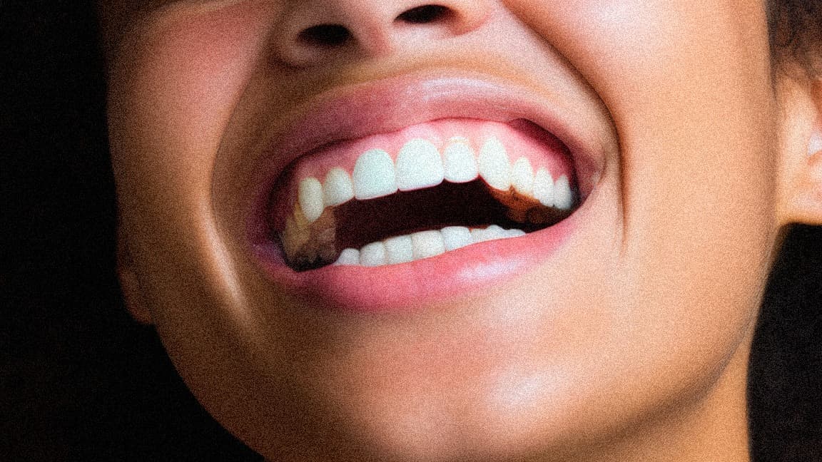 Sorriso gengival